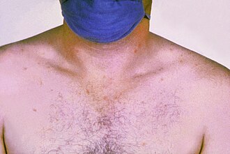 チフス菌による全身性感染症である腸チフスの特徴と歴史