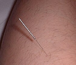 治療に使う鍼